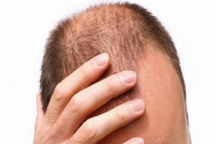 Saçkıran hastalığı nedir?