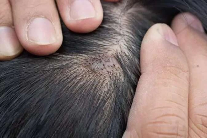 Birçok hastalığın habercisi: Saç diplerinde kaşıntı varsa dikkat