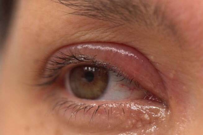 Arpacık nasıl geçer? Arpacık bulaşır mı?