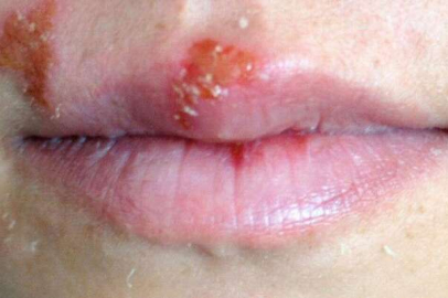 Uçuk deyip geçmeyin! Pek çok soruna neden oluyor!