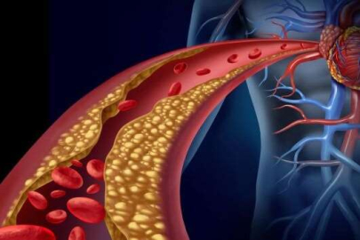 Kolesterol yüksekliğine dikkat! Kolesterol neden yükselir?
