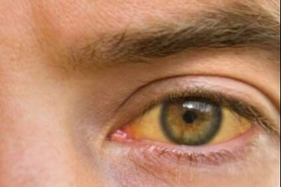 Yazın göz sağlığını korumanın püf noktaları&nbsp;