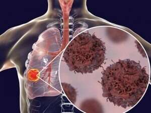 6. Solunum sistemi kanserleri