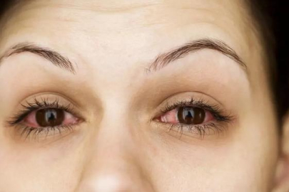 Pakistan'da 'kırmızı göz' alarmı