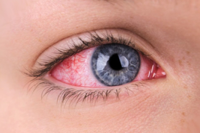 Pakistan'da "kırmızı göz" hastalığına yakalananların sayısı 86 bini geçti