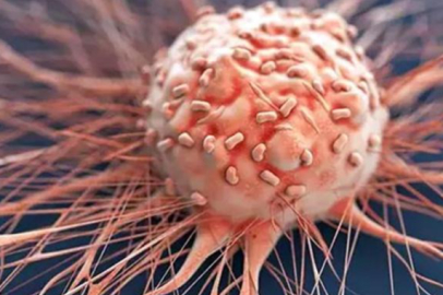 Prostat kanseri: Radyoterapi dozları etkisini azaltabilir