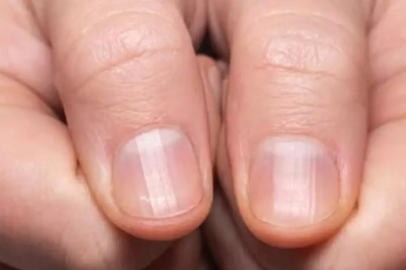 Tırnaklardaki bu değişimlere dikkat: Hastalık habercisi olabilir