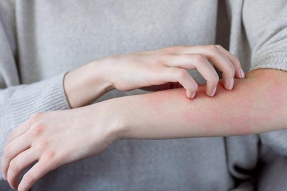 Uzmanlardan 'uyuz' uyarısı: Son yıllarda 3-4 kat arttı