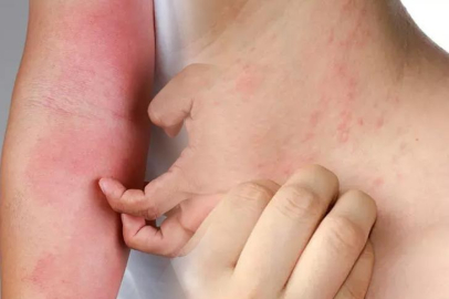 Vakalar her geçen gün katlanarak artıyor! Uzmanlar uyardı...