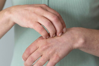 Uyuz vakaları 5 yıldır artış gösteriyor!