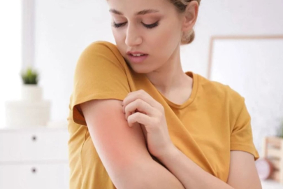 Uyuz vakalarında patlama yaşanıyor