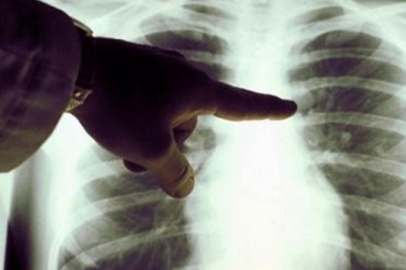 Akciğer kanseri görülme yaşı gittikçe düşüyor