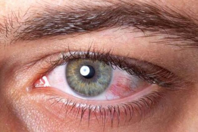 Gözde oluşan tümöre dikkat!