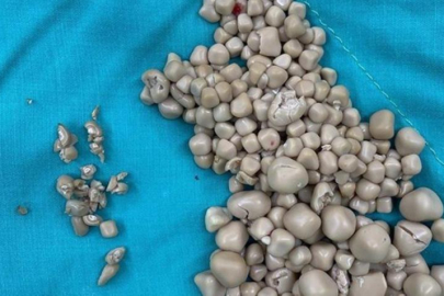 Akılalmaz olay! Böbreklerinden 300 taş çıkarıldı