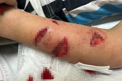 Dehşet! 12 yaşındaki çocuk köpeğin saldırısına uğradı