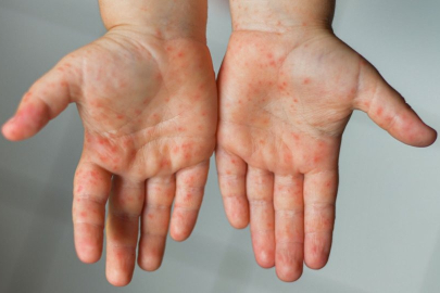 Kawasaki Hastalığı Nedir? Belirtileri Nelerdir?