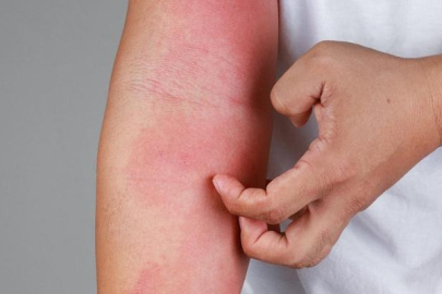 Gece artan kaşıntınız varsa dikkat! Vakalar günden güne arttı...