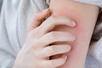 Uyuz vakalarında artış! Doktorlar alarma geçti...