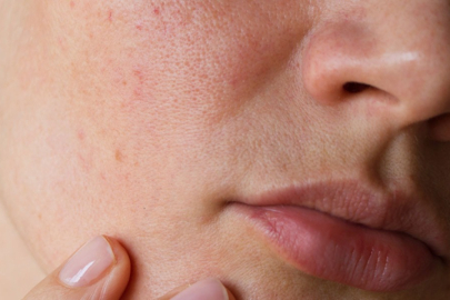 Cilt lekesi neden olur? Çeşitleri nelerdir?