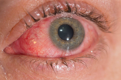 Kadınlarda görülen en sık göz problemlerine dikkat!