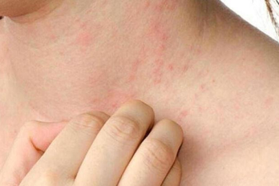 Uzmanından ‘soğuk ısırığı’ uyarısı