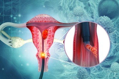 Rahim ağzı kanseri en sık 45-50 yaş arasında görülüyor