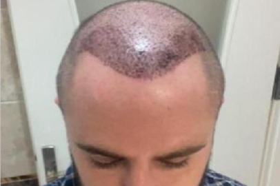 Yaptırdığı saç ekiminin sonucu görünce soluğu mahkemede aldı! Emsal nitelikte karar...