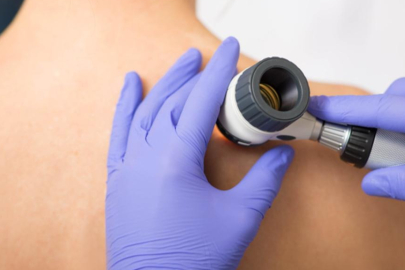 Cilt kanseri için çığır açacak tedavi yöntemi! Onay aldı...