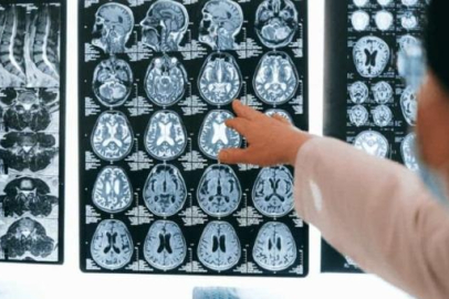 Türk cerrahtan çığır açacak yenilik: Ameliyatsız yok ediyor!