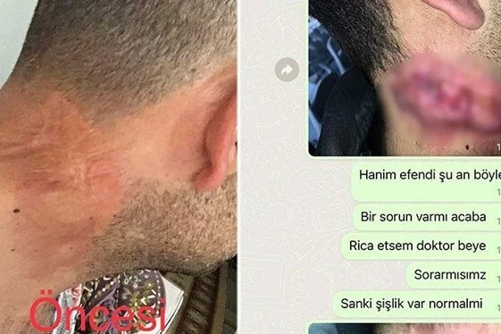 Lazer hayatını kararttı: Tedavi 30 yıl geriye götürdü