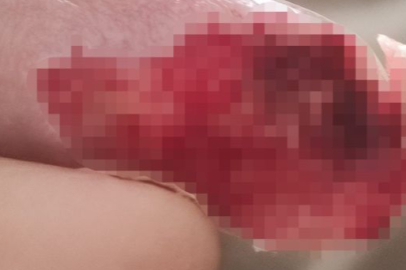 MR çekiminde korkunç olay! Yaşlı kadının parmağı koptu