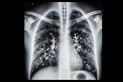 Uzmanından zatürre uyarısı