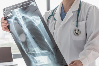 ABD’de rekor seviyede verem salgını