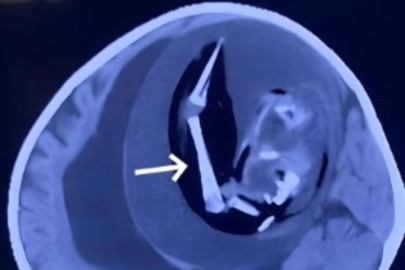 Doktorları şaşkına çeviren röntgen görüntüsü! Bebeğin kafatası...