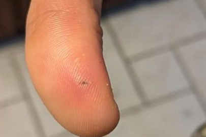 Soğan soyarken kabuğu elini kesince hastanelik oldu!