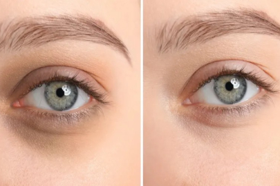 Göz altı morluğu neden olur? Nelere dikkat edilmeli?