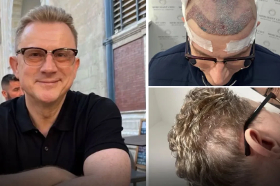 Saç ekimi felakete dönüştü! İşini bırakmak zorunda kaldı