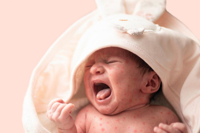 Dünyada kızamık salgını alarmı! Hastanede alarm verildi: Yenidoğan bebekler tehlikede