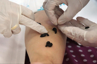 Tıbbi sülük kullanım esaslarında düzenleme