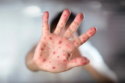 ABD'nin Teksas eyaletindeki kızamık salgınında vaka sayısı 500'e yükseldi