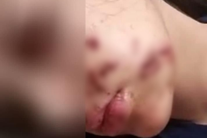 Siirt'te yüzüne maytap isabet eden genç kız yaralandı