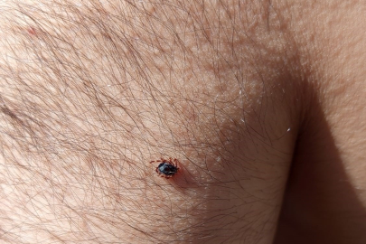 Kayseri’nin bir ilçesinde daha kene vakası