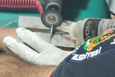 Şanlıurfa'da çocuğun parmağına sıkıştırdığı cıvata pulu kesilerek çıkartıldı