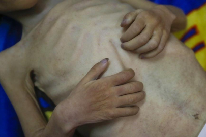 Gazze'de açlıktan ölenlerin sayısı günbegün artıyor