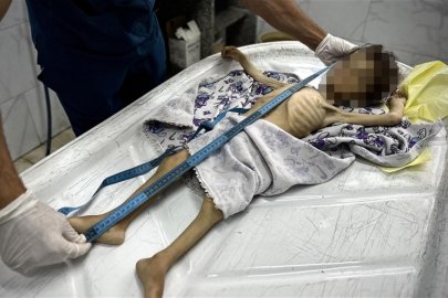 İngiliz patolog: Gazze'deki sefalet bir halkın diğerine neler yapabileceğini gözler önüne serdi