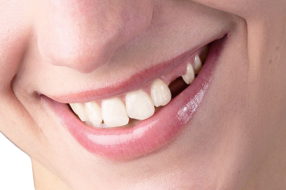 Diş kaybına neden olan faktörlere dikkat