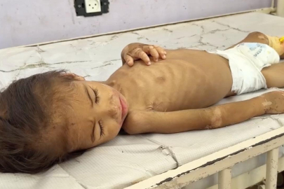 Gazze'de açlık savaşı: 2 yaşındaki İmad yaşam mücadelesi veriyor