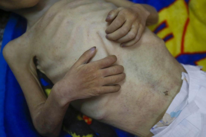 Katil İsrail'in ablukası altındaki Gazze’de açlıktan ölenlerin sayısı 455’e yükseldi