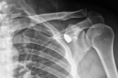 Yorgun mermi 6 yıl sonra çıkarıldı! Omza giren mermi koltuk altından çıktı