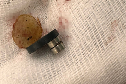 Bebeğin yuttuğu mıknatıslar bağırsak delinmesine neden oldu